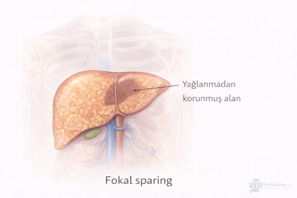 Fokal Sparing (Yağlanmadan Korunmuş Alan) – Batın, BT, MR radyoloji terimi için şematik gösterim.