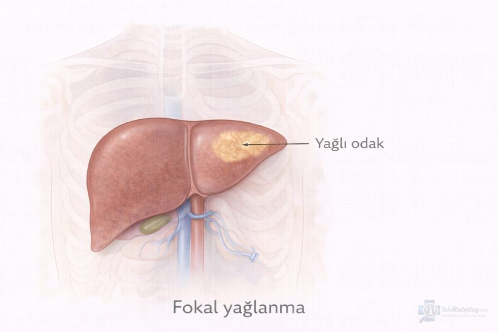 Fokal Yağlanma (Odaksal Yağ İnfiltrasyonu) – Batın, BT, MR radyoloji terimi için şematik gösterim.