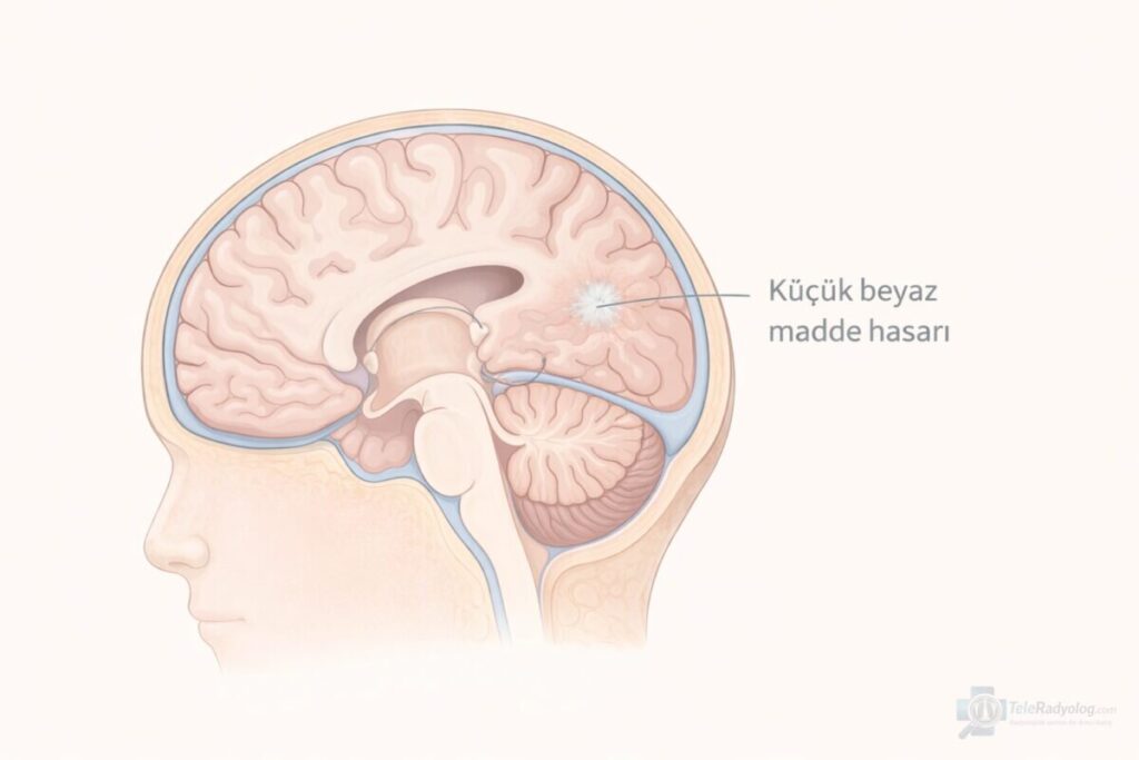 İskemik gliotik odak – Beyin, MR radyoloji terimi için şematik gösterim. Bilgilendirme amaçlı görsel anlatım.